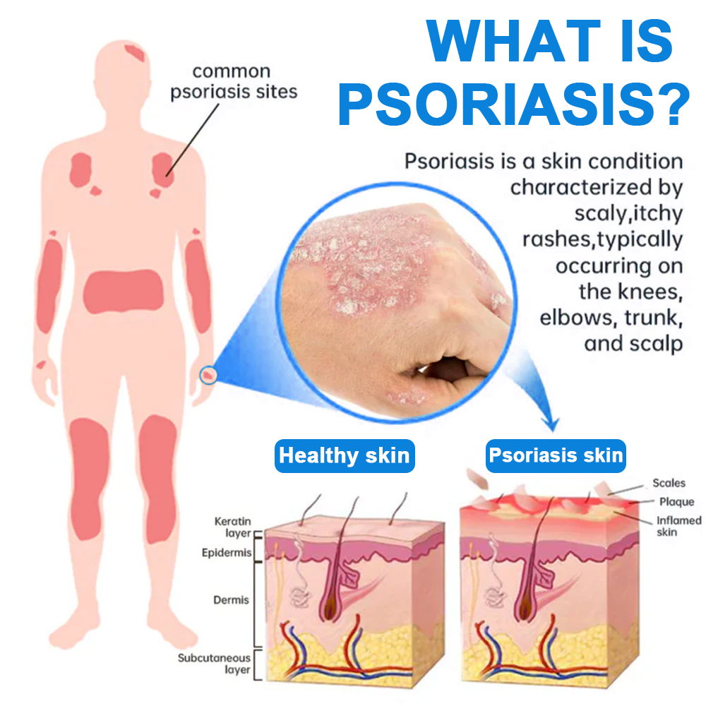 ✅ Official Store: Cvreoz® Magnesium Herbal Psoriasis Spray 👨‍⚕️ MHRA Approved (Relieves psoriasis and eczema, improves bacterial infections in the genital area, treats acne and warts) (Copy)