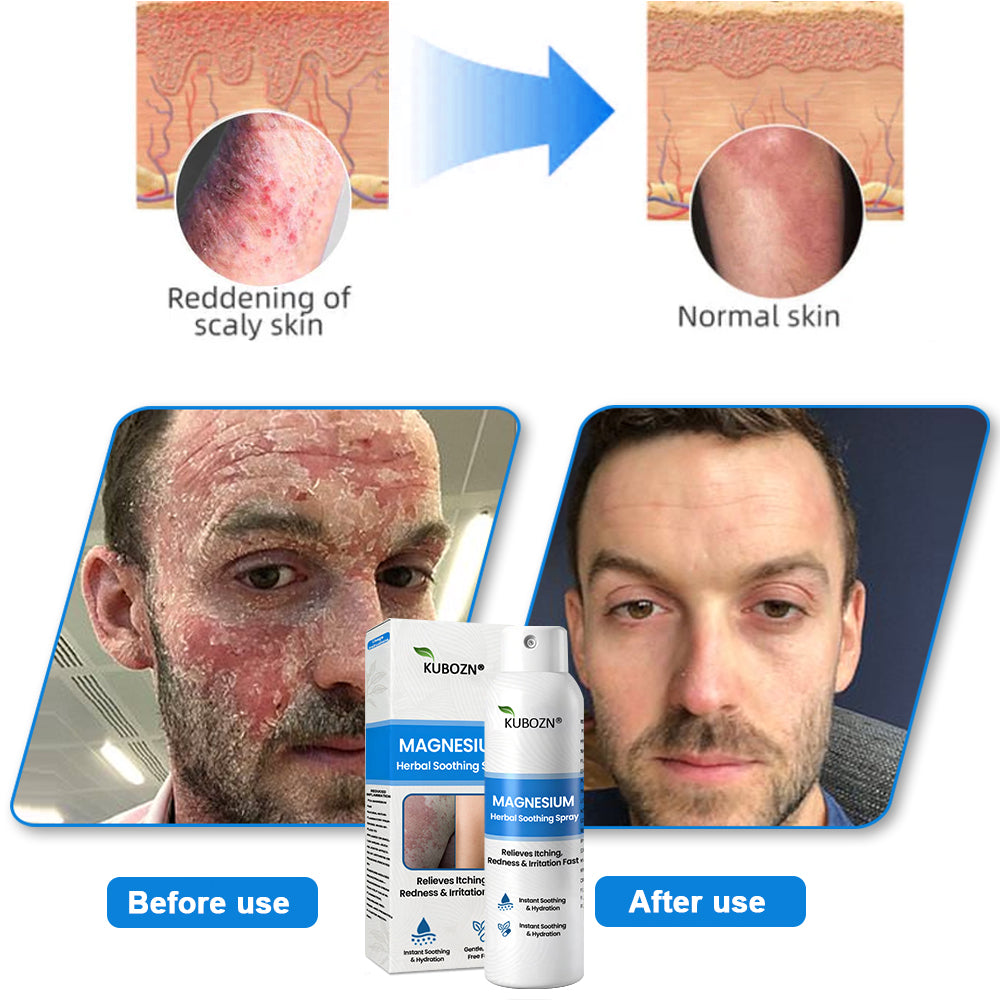 ✅ Official Store: Kubozn® Magnesium Herbal Psoriasis Spray 👨‍⚕️ MHRA Approved (Relieves psoriasis and eczema, improves bacterial infections in the genital area, treats acne and warts) (BIGO)