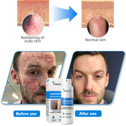 ✅ Official Store: Kubozn® Magnesium Herbal Psoriasis Spray 👨‍⚕️ MHRA Approved (Relieves psoriasis and eczema, improves bacterial infections in the genital area, treats acne and warts) (BIGO)