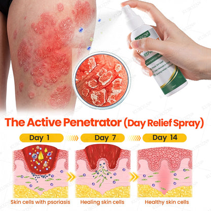 KUBOZN® Psoriasis Day & Night Repair System - 100% Steroid-Free Relief Duo for Plaques, Scaling & Itch (offer)