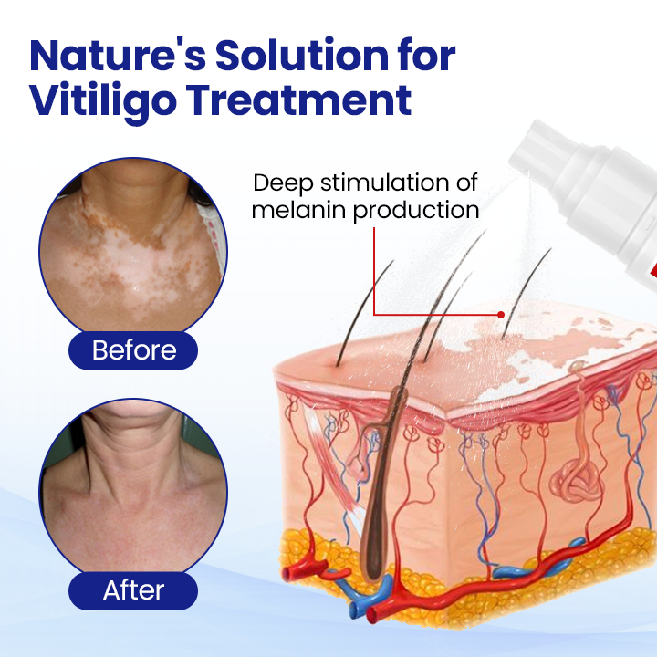 Cvreoz® Vitiligo Treatment Spray 🌿 Herbal Formula Certified — (Supports Repigmentation, Prevents New Spots, and Restores Natural Skin Tone Without Steroids)