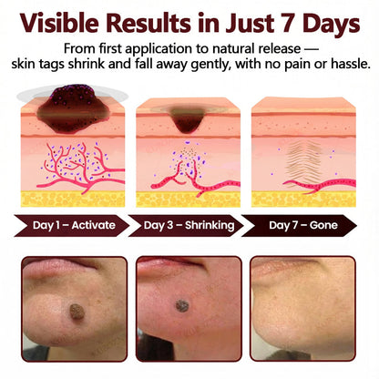 KUBOZN® OryzaDarts TAG’GONE Patch✨Pain-Free Root-Level Removal Powered by Black Rice MicroDarts.