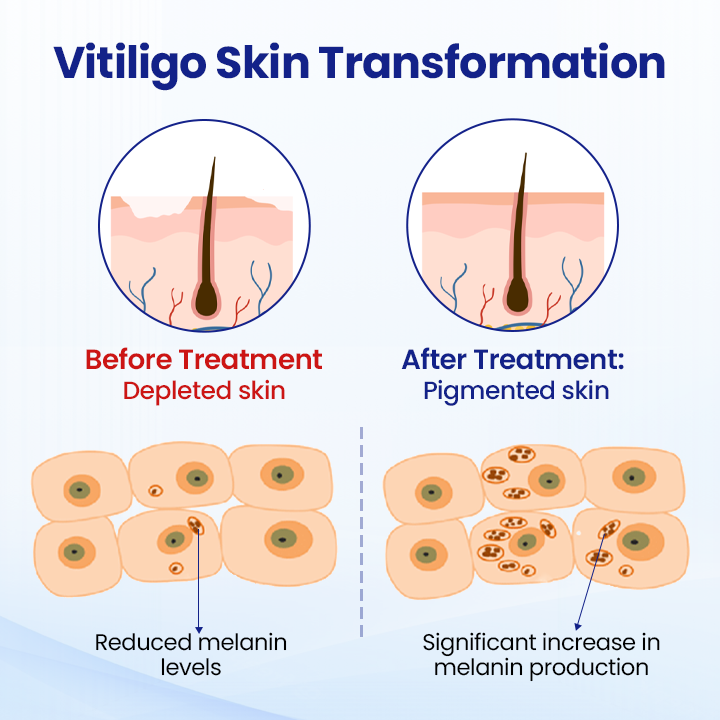 Cvreoz® Vitiligo Treatment Spray 🌿 Herbal Formula Certified — (Supports Repigmentation, Prevents New Spots, and Restores Natural Skin Tone Without Steroids)