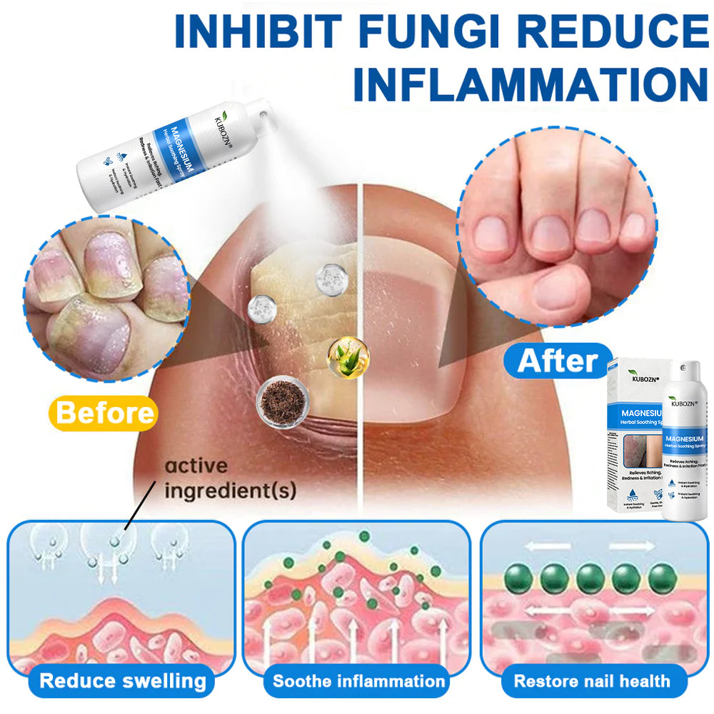 ✅ Official Store: Kubozn® Magnesium Herbal Psoriasis Spray 👨‍⚕️ MHRA Approved (Relieves psoriasis and eczema, improves bacterial infections in the genital area, treats acne and warts) (BIGO)