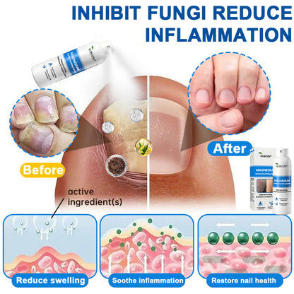 ✅ Official Store: Kubozn® Magnesium Herbal Psoriasis Spray 👨‍⚕️ MHRA Approved (Relieves psoriasis and eczema, improves bacterial infections in the genital area, treats acne and warts) (BIGO)