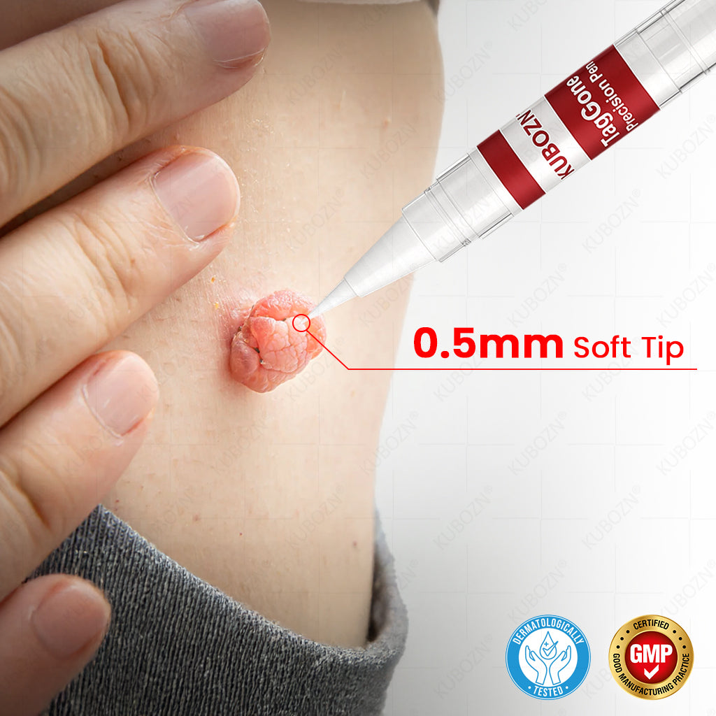 ✨KUBOZN® TagGone Precision Pen (2025 Upgrade) | Skin Tag, Mole & Wart Remover – Fast, Gentle & Scar-Free in 5 Days (offer)